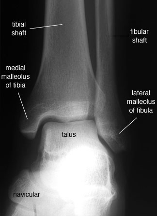 Radiographic Anatomy of the Skeleton: Ankle -- Anteroposterior (AP