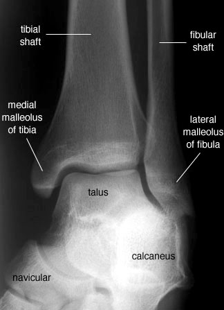 Radiographic Anatomy of the Skeleton: Ankle -- Mortise View, Labelled