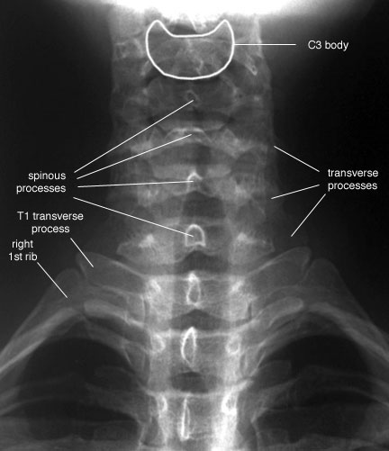 Radiographic Anatomy of the Skeleton: Cervical Spine -- Anteroposterior