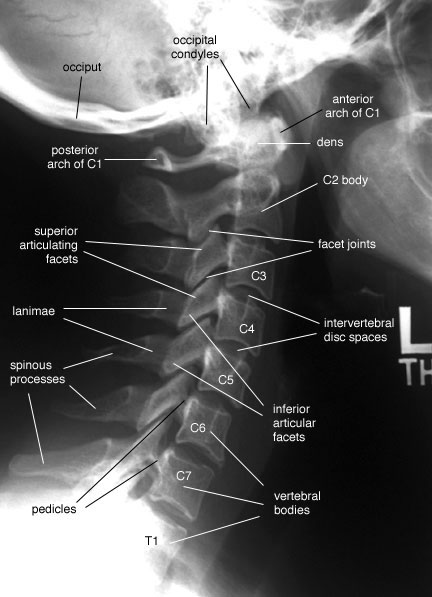 Radiographic Anatomy of the Skeleton: Cervical Spine -- Lateral View