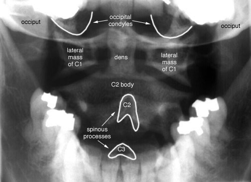 Radiographic Anatomy of the Skeleton: Cervical Spine -- Open Mouth