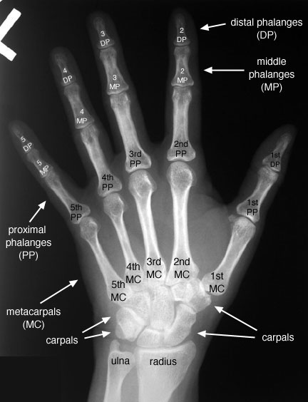 Hand Xray Bones