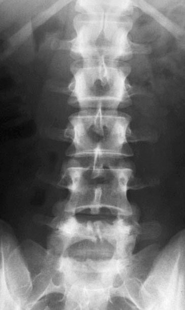 Radiographic Anatomy of the Skeleton: Lumbar Spine -- Anteroposterior