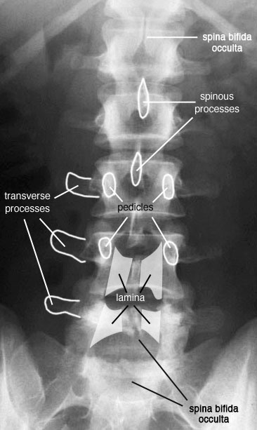 Radiographic Anatomy of the Skeleton: Lumbar Spine -- AP View, Labelled