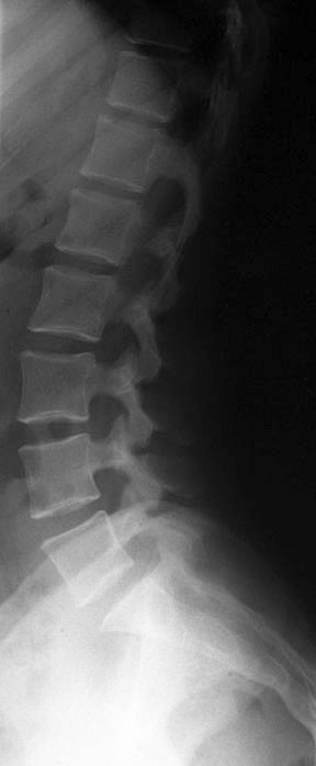 Radiographic Anatomy of the Skeleton: Lumbar Spine -- Lateral View