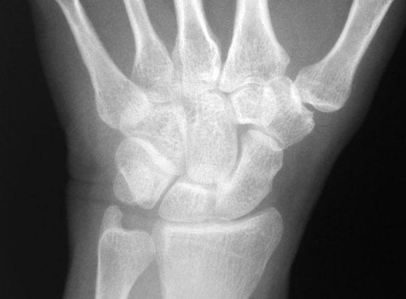 Radiographic Anatomy Of The Skeleton Wrist Posteroterior PA View 