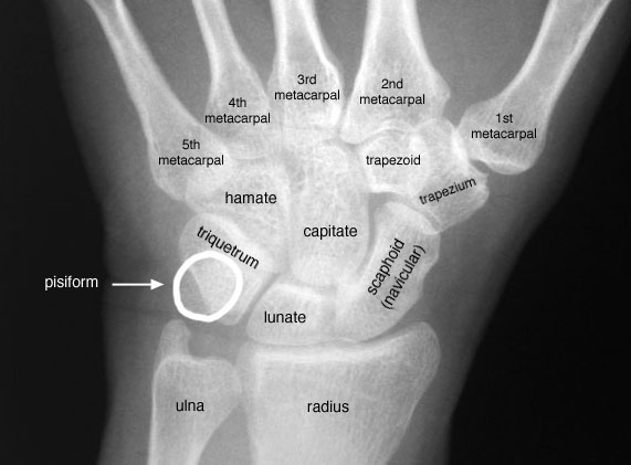 Radiographic Anatomy of the Skeleton: Wrist -- Posteroterior (PA) View