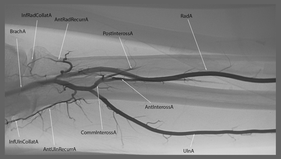 Labeled Angiograms