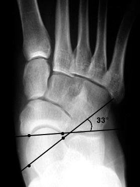 b. Talonavicular uncoverage indicating pes planus.