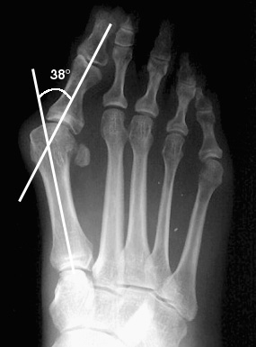 b. Abnormal 1st metatarsophalangeal angle consistent with hallux valgus.
