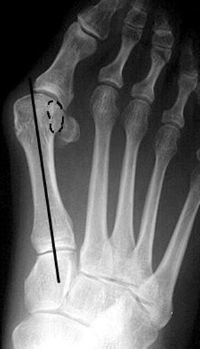 b. Hallux valgus with medial sesamoid completely lateral to mid-axis line corresponding to station 3, indicating significant "lateral subluxation" of the sesamoid.