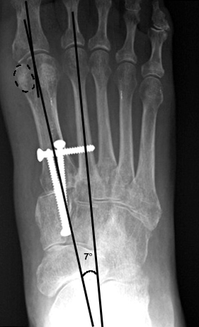 b. Same patient after modified Lapidus procedure showing correction of all three abnormal parameters.