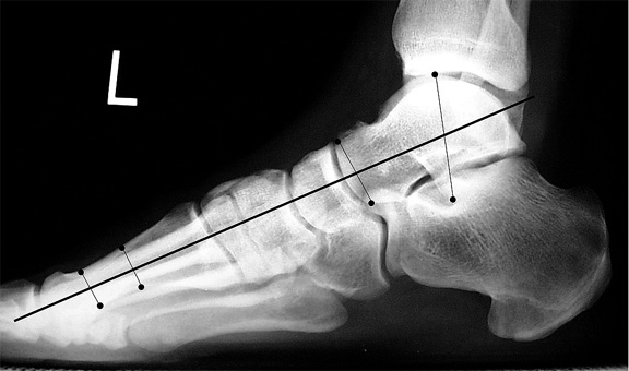 Normal Meary's angle. The long axis of the talus intersects that of the first metatarsal