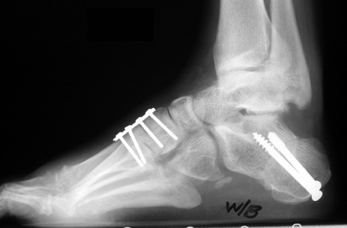 c. Lateral view showing both 1st TMT fusion and lateralizing calcaneal osteotomy.