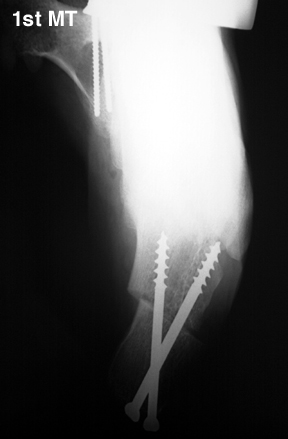 b. Lateralizing calcaneal osteotomy to correct hindfoot varus.