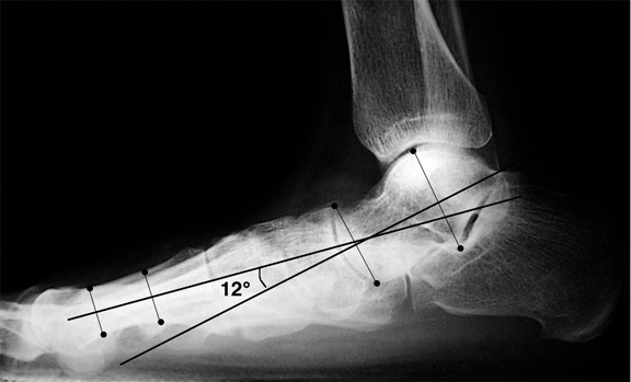 icd 10 code for pes planus