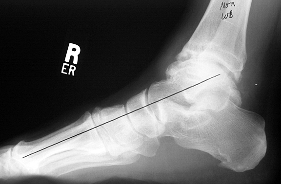 xray of normal foot