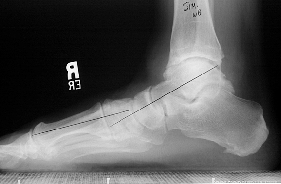 normal foot xray lateral