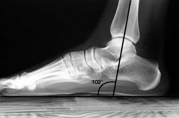 Introduction Foot Alignment 8930