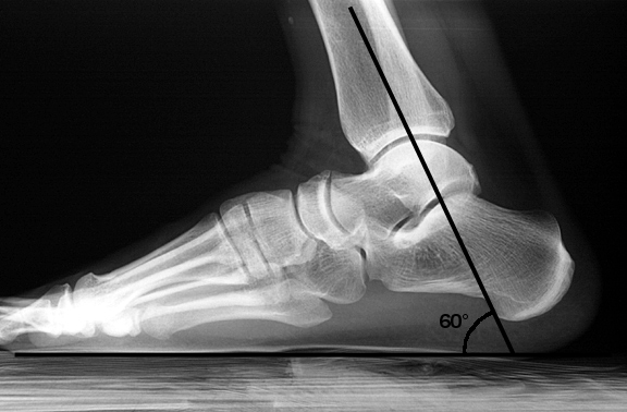 Partial weight-bearing. Note that the tibia is angled relative to the floor.