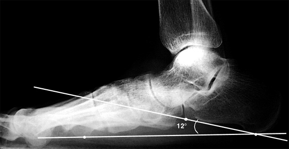 b. Decreased calcaneal pitch indicating pes planus.