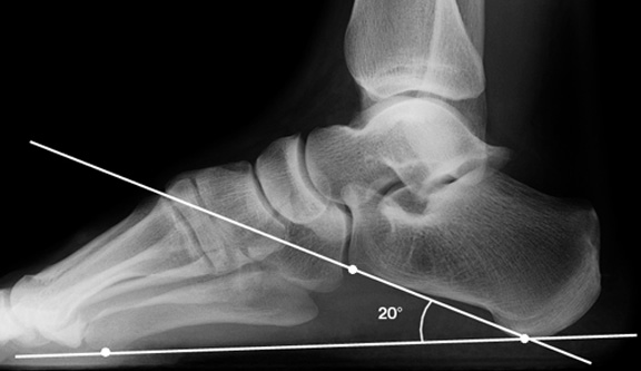 a. Normal calcaneal pitch.