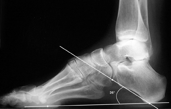 b. Abnormally high calcaneal pitch consistent with pes cavus.