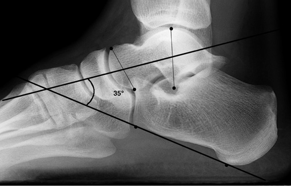 a. Normal lateral talocalcaneal angle.