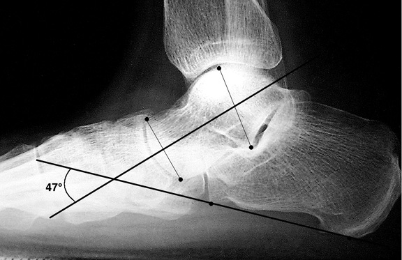 The Cotton Osteotomy in Flexible Flatfoot Correction