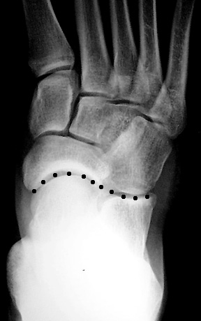 a. Normal AP cyma line: Line between talonavicular joint and calcaneocuboid joint is smooth and continuous.