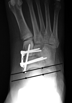 b. Postoperative view after medial column stabilization showing correction of this talonavicular uncoverage.