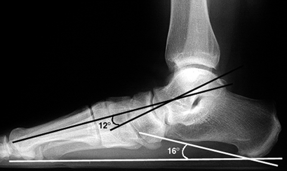 pes planus deformities