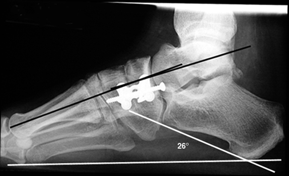 b.Post-operative view after medial column stabilization, showing correction of these angles to normal.