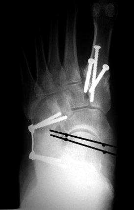 b. Postoperative views after lateral column lengthening (and medial column stabilization) showing reduction of the lateral peritalar subluxation.