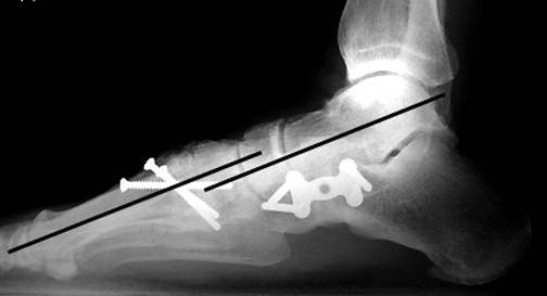 b. Post-operative lateral view after lateral and medial column stabilization, showing correction of these angles to normal.