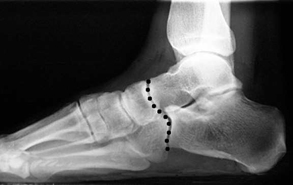 a. Line connecting talonavicular joint and calcaneocuboid joint is smooth and continuous.