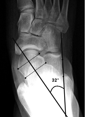 pes planovalgus