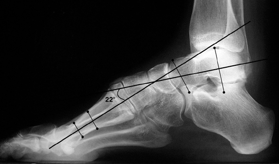 pes planus icd 10