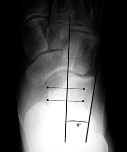 pes cavus deformity