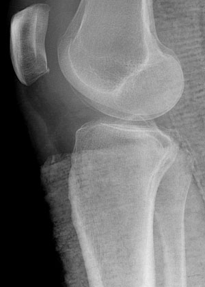 Lateral Radiograph of Right Knee
