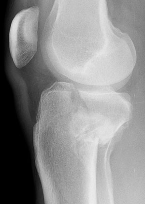 Lateral Radiograph of Right Knee