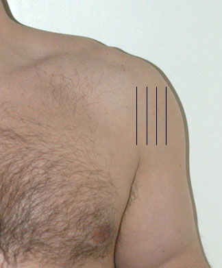 Posterior left shoulder