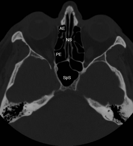 sagittal ethmoid sinus