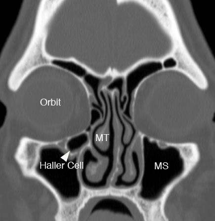 Ethmoid Sinus Normal Anatomy Variants Ethmoid Sinus Normal Anatomy Variants