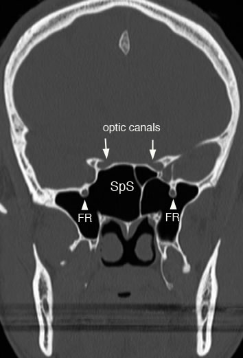 sphenoid foramen