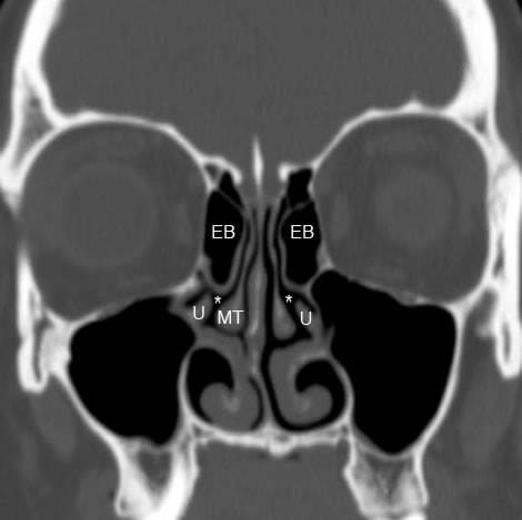 sagittal ethmoid sinus