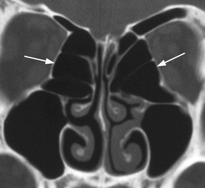 Ethmoid Sinus: Normal Anatomy & Variants