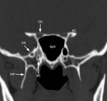 sphenoid bone optic foramen
