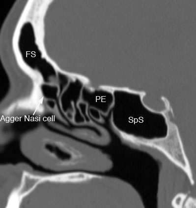 sagittal ethmoid sinus