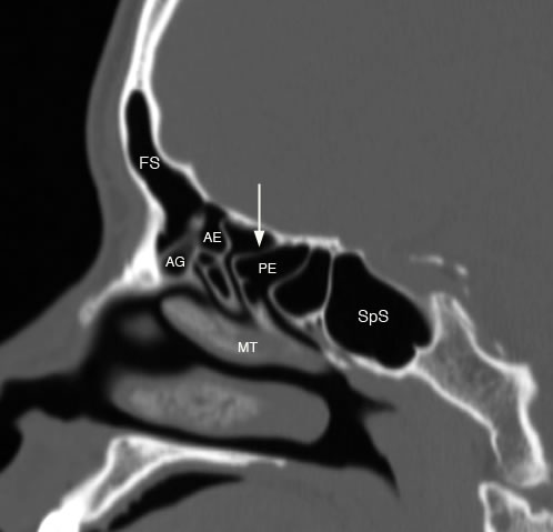 sagittal ethmoid sinus